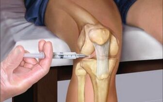 intra-articular injection into the joint due to arthrosis