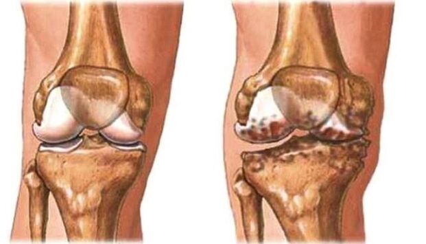 healthy knees and knee osteoarthritis