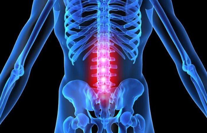 Osteochondrose of the lumbar region