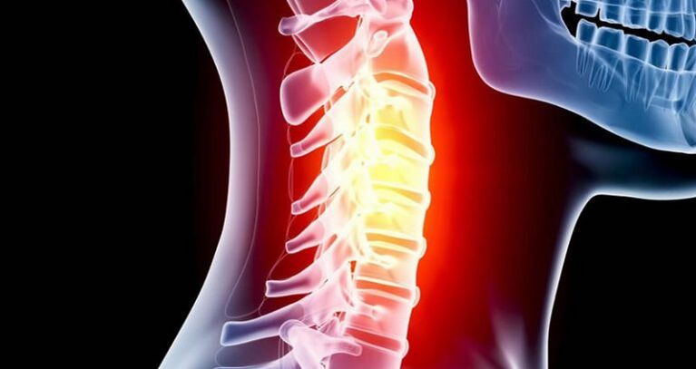 Inflammation of cervical regions