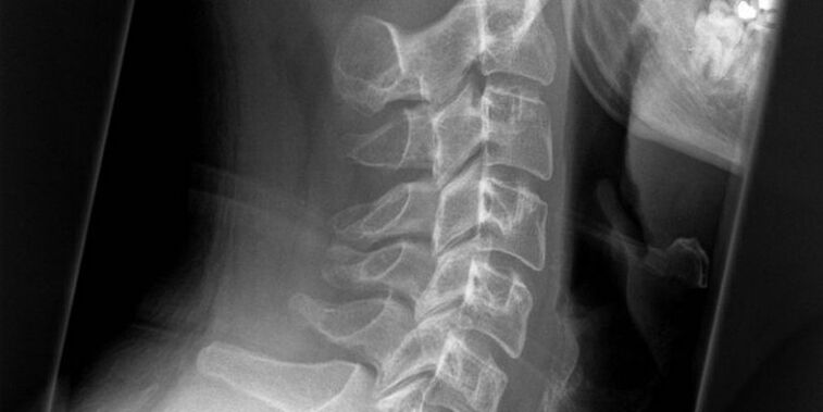 Picture of the cervical region