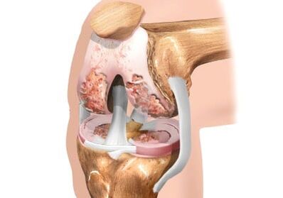 Damage to the Arthrosis of the Common Knee