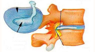 Cervical Osteochondrose Development Features