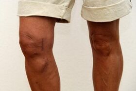 swelling of the knee joint due to arthrosis