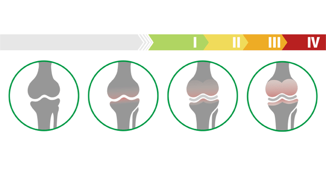 stages of atrophy